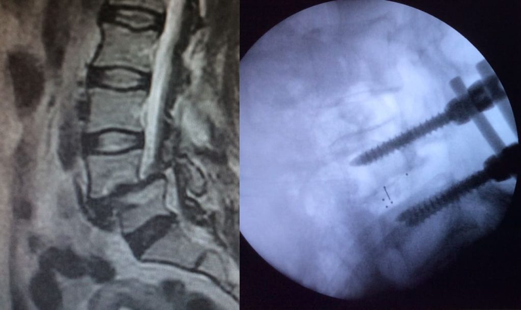 Izquierda: RM preoperatoria. Derecha: control intraoperatorio.