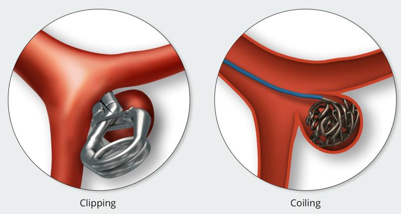 Aneurisma cerebral tratado mediante clipaje (izquierda) o mediante coiling (derecha). 