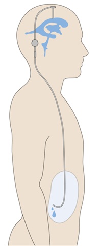 Ilustración que muestra esquema de una derivación ventrículo-peritoneal con una válvula interpuesta.