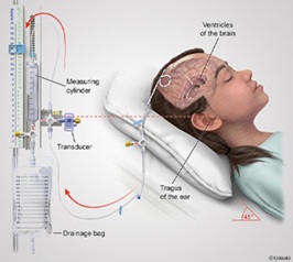Ilustración que muestra un esquema de un drenaje ventricular externo.