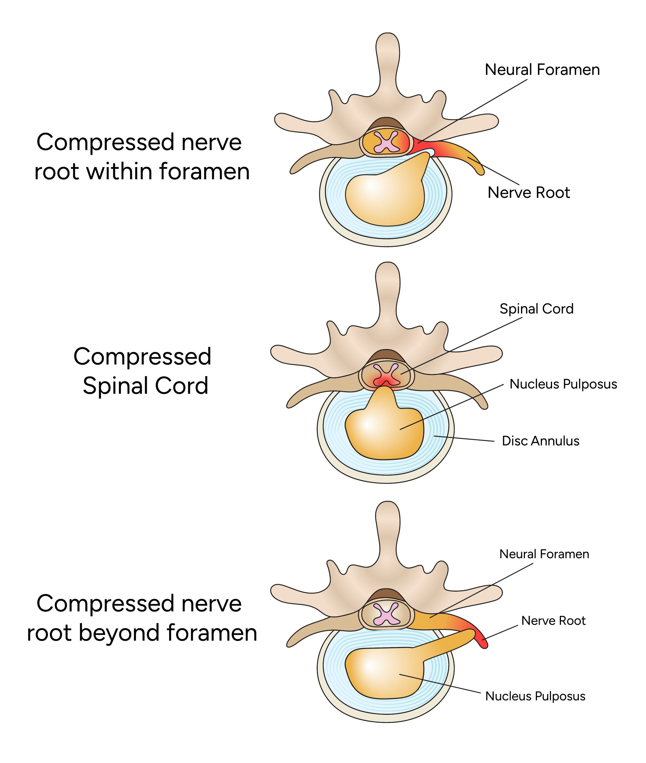 Anatomía de una hernia de disco lumbar 