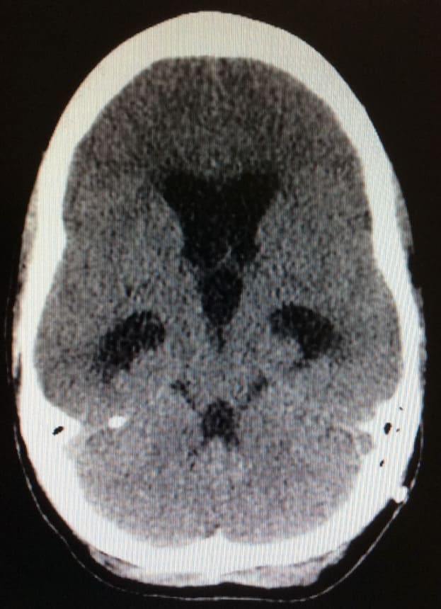 Imagen radiológica de TAC craneal que muestra una hidrocefalia (aumento de tamaño de los ventrículos en negro).