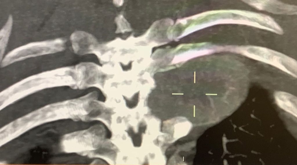 Metástasis vertebral dorsal. Caso tratado por Dr. Antonio López González, NC+.