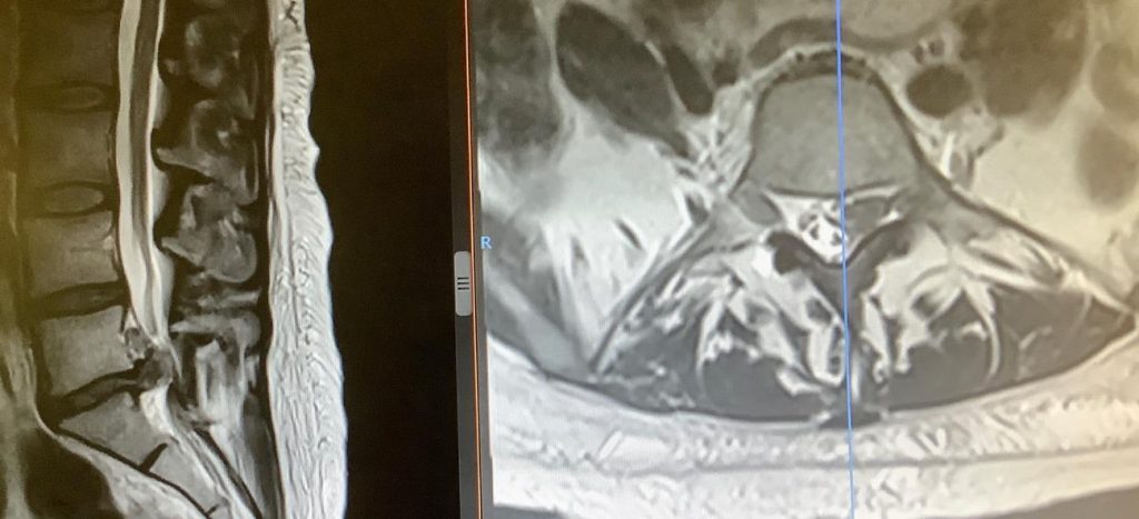 Ejemplo clínico: Hernia discal L5-S1 izquierda extruida  