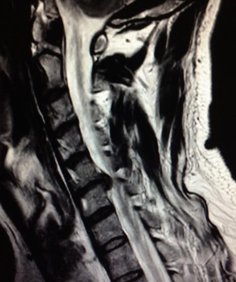 Imagen intraoperatoria de inserción de caja intersomática tras discectomía cervical
