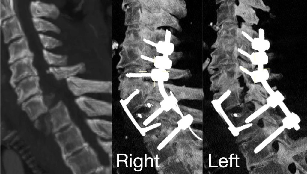 reconstrucción fractura luxación cervical