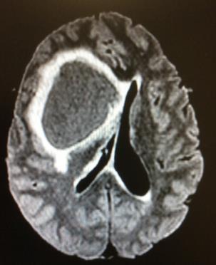 Imagen radiológica de gran tumor cerebral (glioma) 