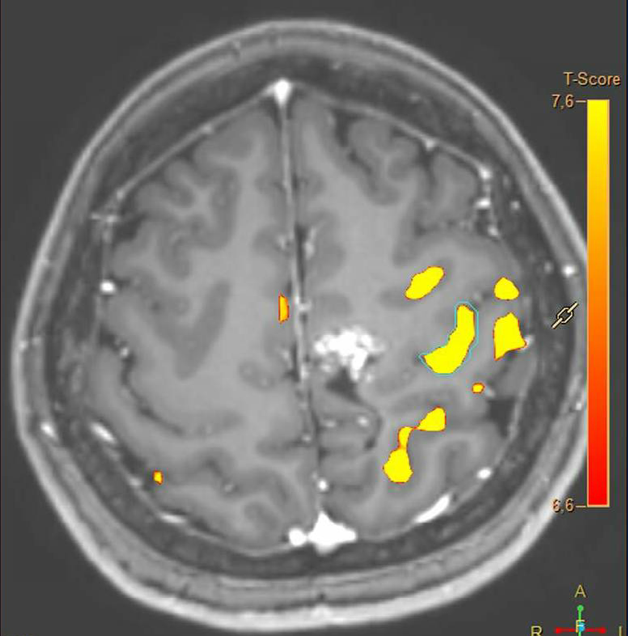 Resonancia funcional cerebral.