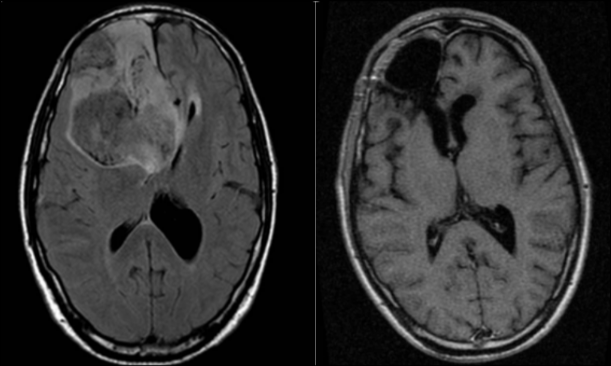 Izquierda: imagen preoperatoria: de resonancia magnética cerebral mostrando tumor antes de cirugía. Derecha: imagen postoperatoria de resonancia magnética cerebral tras resección de tumor. NC+ Sevilla.