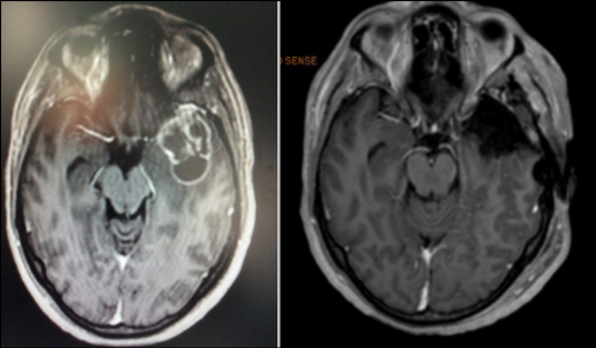 Izquierda: Imagen de RM que muestra un tumor cerebral maligno (glioblastoma). Derecha: Imagen RM postoperatoria. Caso tratado por Dr. Antonio López González, NC+