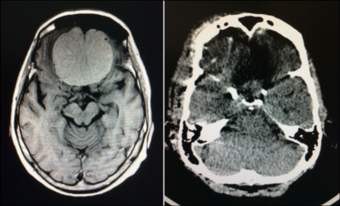 Izquierda: Imagen de RM que muestra un meningioma de base de cráneo. Derecha: Imagen de TAC que muestra la extirpación postquirúrgica. Caso tratado por Dr. Antonio López, NC+.