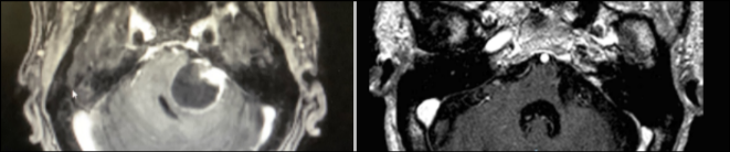 Izquierda: imagen de RM cerebral que muestra un neurinoma del VIII par. Derecha: imagen de RM de poros acústicos que muestra la extirpación completa. Caso tratado por Dr. Antonio López González, NC+.