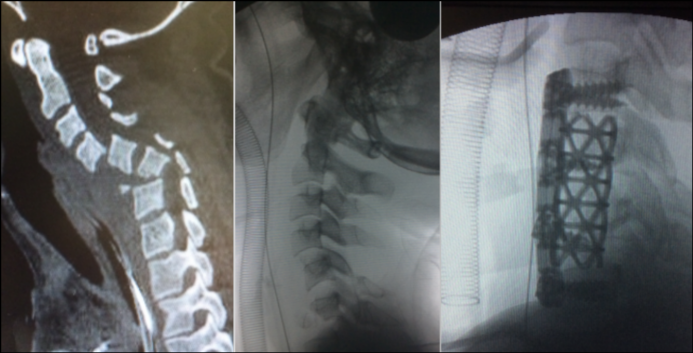 reconstrucción fractura luxación cervical
