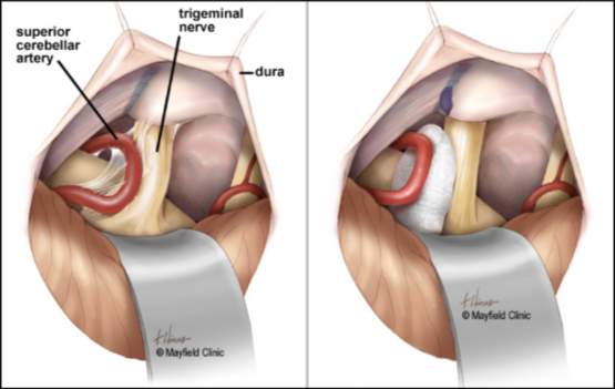 Izquierda: ilustración que muestra compresión del nervio trigémino por arteria cerebelosa superior. Derecha: ilustración que muestra la separación de la arteria del nervio tras disección e interposición de teflón.