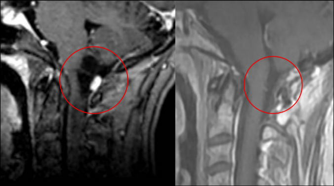 Tumor intramedular en bulbo raquídeo con componente sólido y quístico tabicado, caso tratado por Dr. Antonio López González, NC+