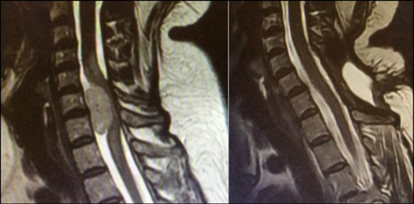 Izquierda: imagen de RM que muestra un meningioma medular cervical. Derecha: imagen de RM postquirúrgica que confirma la extirpación de la lesión.