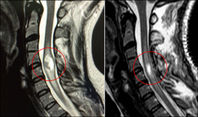 Ependimoma intramedular cervical, imagen radiológica, caso tratado por Dr. Antonio López