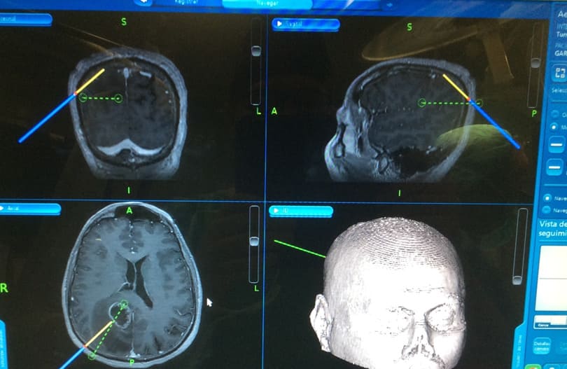 Visión de neuronavegación intraoperatoria en un caso de un tumor cerebral.