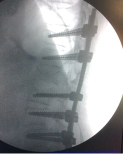 artrodesis dorsolumbar percutánea por fractura vertebral