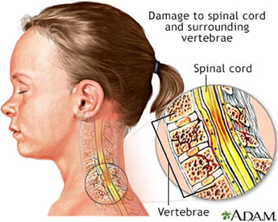 Fractura vertebral cervical y contusión medular